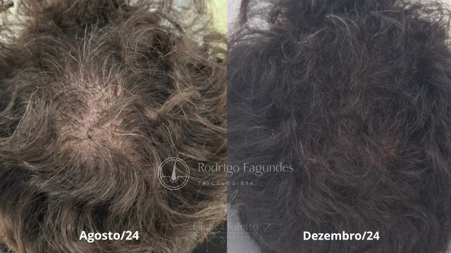 Tricologia: demanda crescente de ciência dedicada à saúde dos cabelos e couro cabeludo